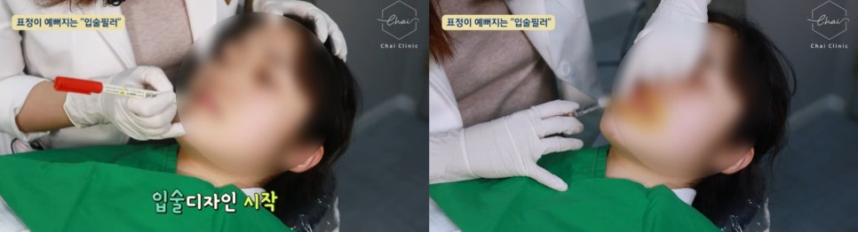 말린입술 필러로 나만의 도톰한 입술을 찾으세요 관련 이미지 6