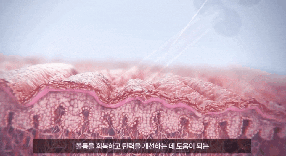 합정 사각턱보톡스 주기 및 효과 차이나는 이유! 관련 이미지 10