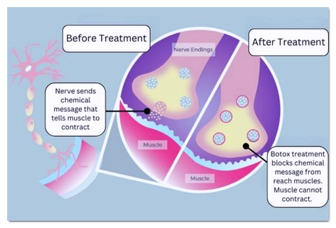 Two Ways to Get Botox in Mapo at a Good Value image 8