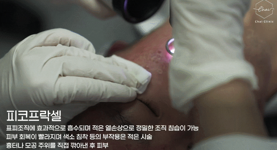 여드름 흉터 레이저, 피코프락셀과 같이 하면 좋은 것은? 관련 이미지 2