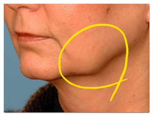 Three Common Cases That Can Lead to Botox Side Effects Near Hapjeong Station image 3