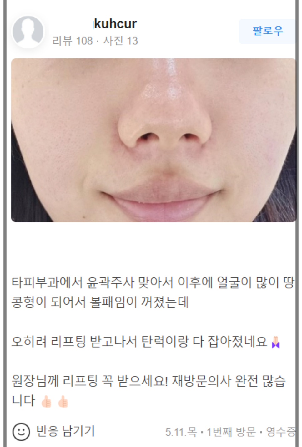 입꼬리보톡스 예쁜 미소 완성하는 차이의원 관련 이미지 13