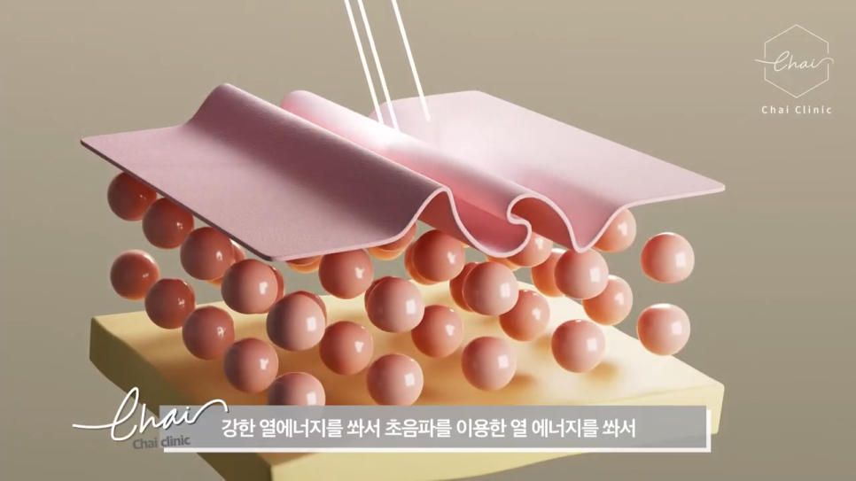 서교동 울쎄라 부작용 없이 시술하려면 관련 이미지 3