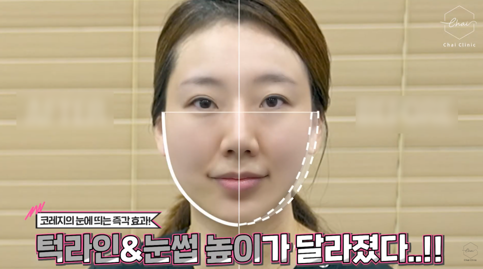 How to Achieve Thermage-Like Results with Corage Lifting image 6