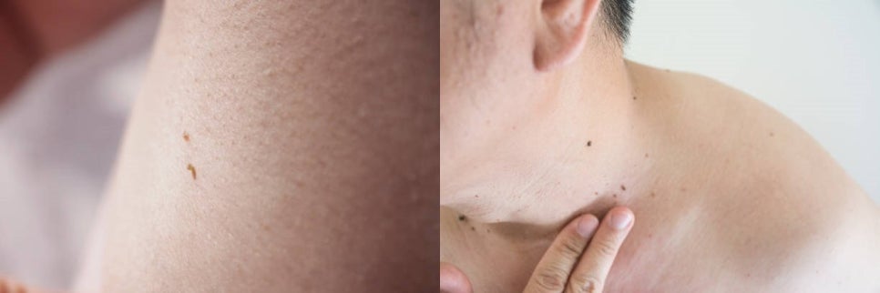 얼굴 빽빽하게 뒤덮은 사마귀 레이저로 박살 내기 관련 이미지 2