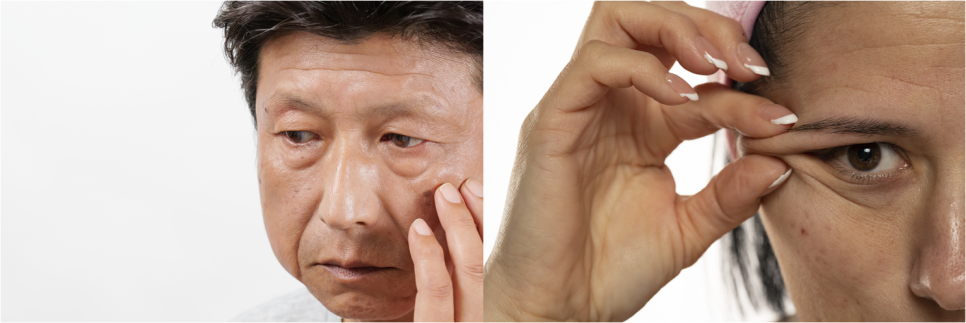 눈썹리프팅 효과 확실한 차이 느낄 수 있는 곳 관련 이미지 2