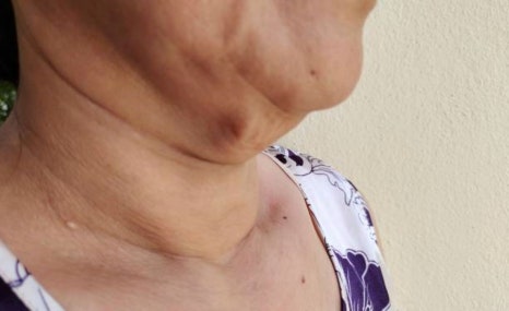 합정 블루다이아리프팅 비용, 5세대 실리프팅은 더 좋나요? 관련 이미지 2