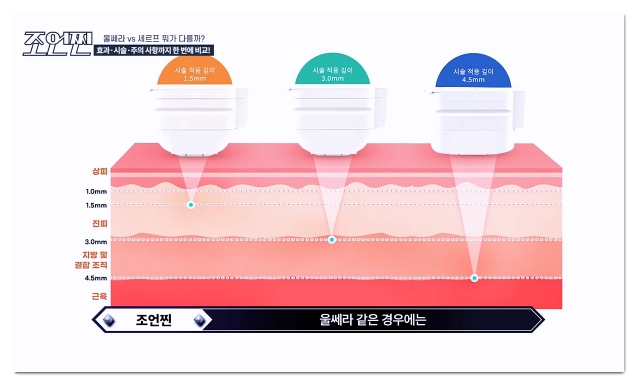 합정 울쎄라 팔자주름 심부볼은 이렇게 맞으세요 3가지 방법 관련 이미지 7