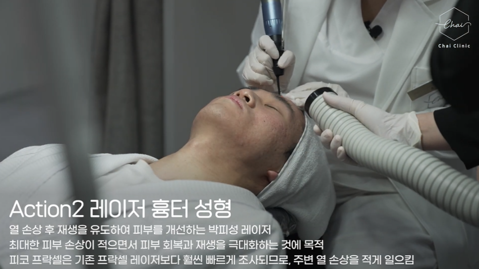 여드름흉터 시술 유형별로 달라야 하는 까닭은? 관련 이미지 3