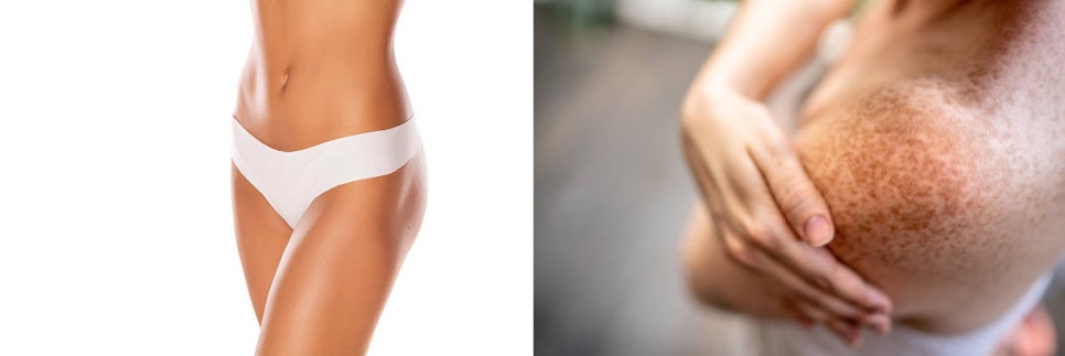 홍대여의사피부관리 늦기 전에 색소침착에서 벗어나는 법 관련 이미지 10