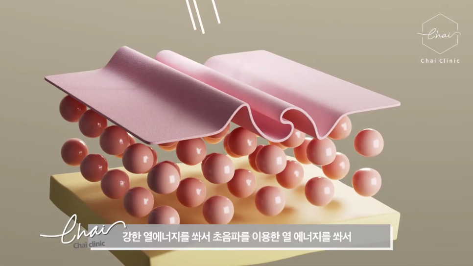 홍대 울쎄라, 여름 다이어트는 성공했는데 얼굴 OO은 그대로라면? 관련 이미지 12