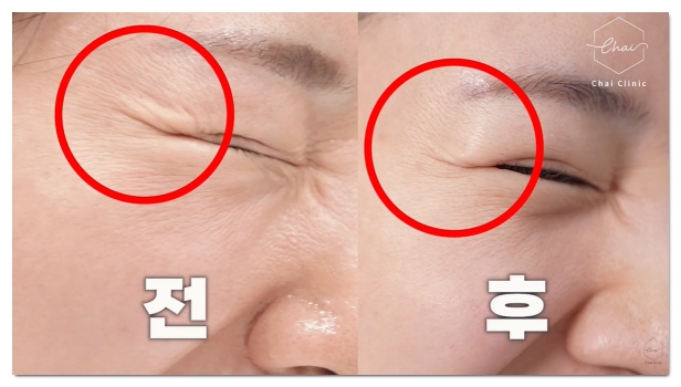Differences and Effect Comparison Between Eye Thermage and Eye Ultherapy image 10