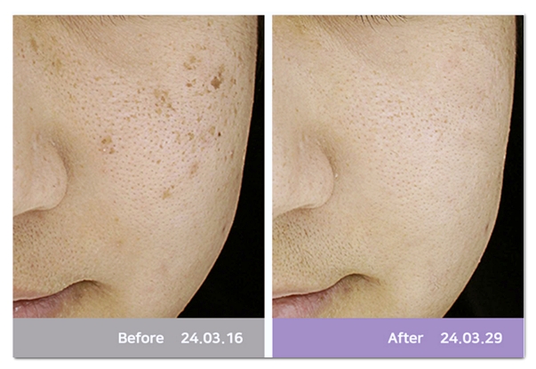 No Results from Hongdae Pico Toning? Check These 5 Things image 2