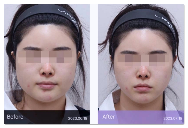 합정 보톡스 잘하는 병원 고르는 방법 관련 이미지 9
