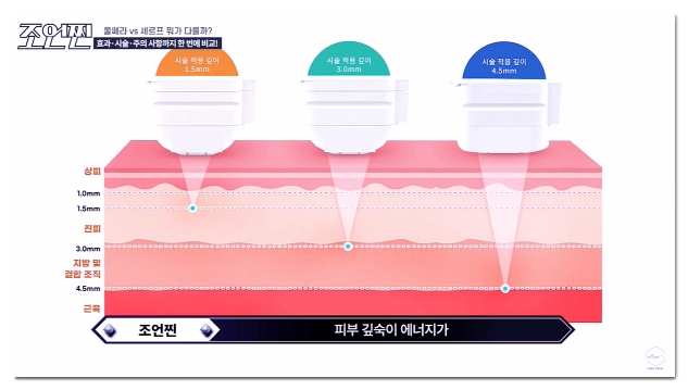 합정 울쎄라 효과 없었던 이유 4가지 관련 이미지 7