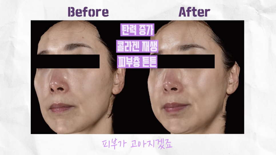 리쥬란 쥬베룩의 차이와 효과의 시너지에 대해 관련 이미지 10
