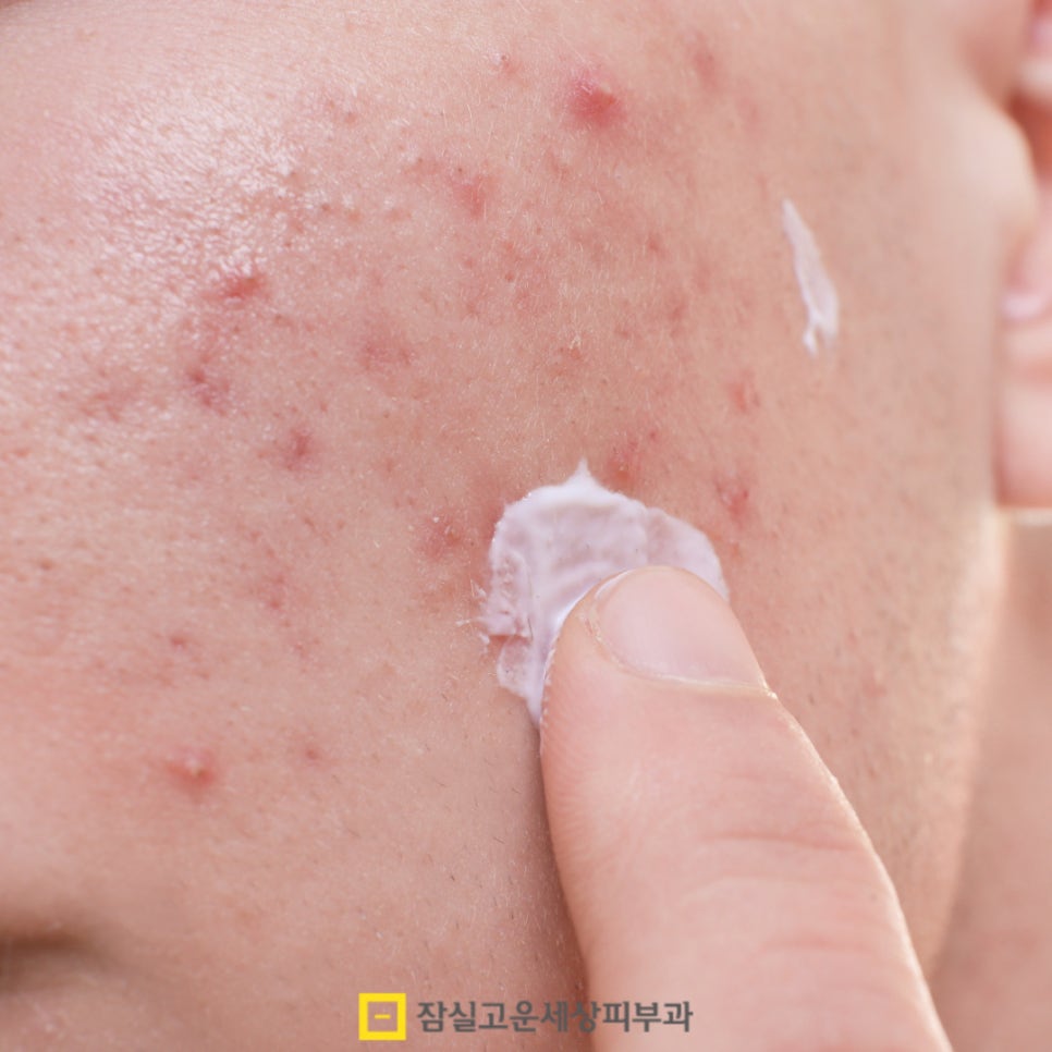 여드름 색소침착, 자연치유를 돕는 관리법 관련 이미지 6