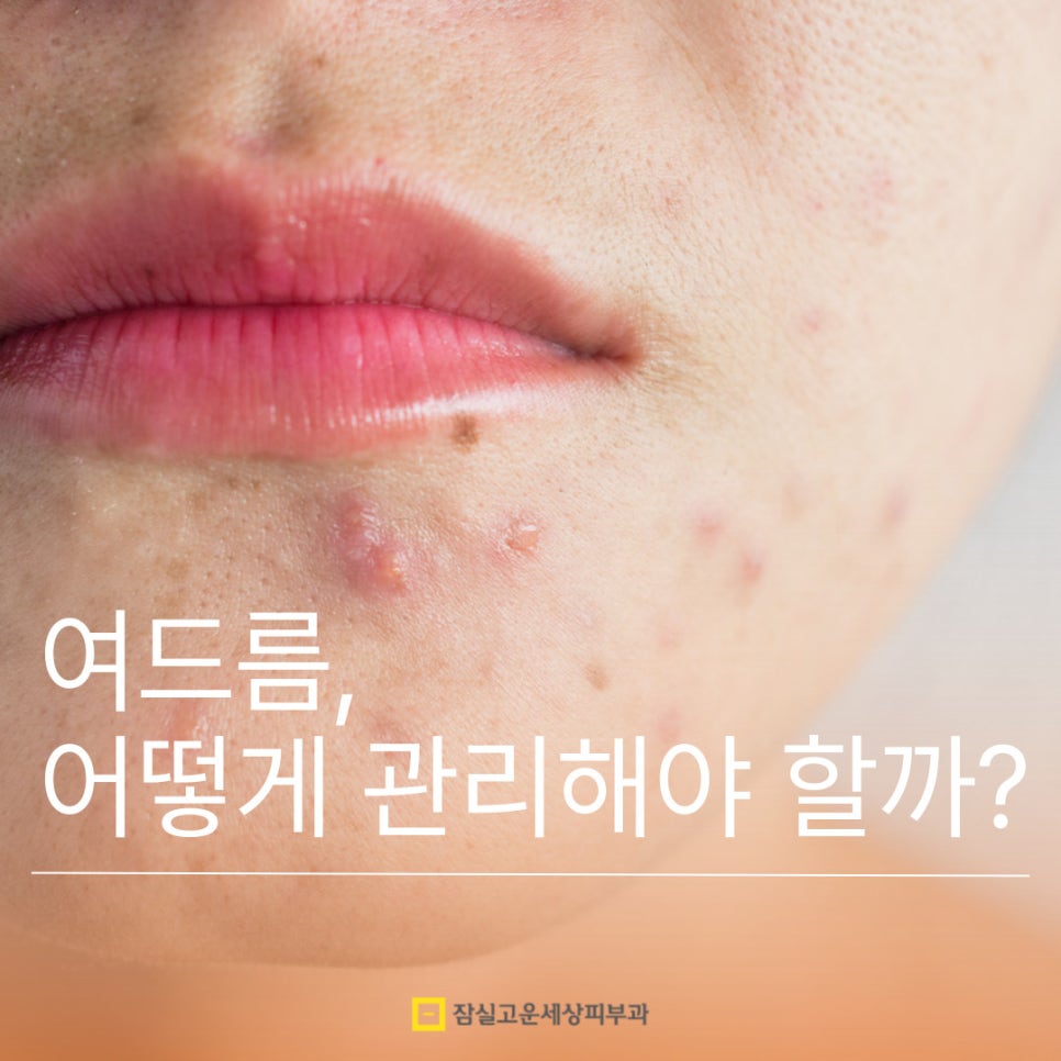 여드름 어떻게 관리해야 할까? 관련 이미지 1
