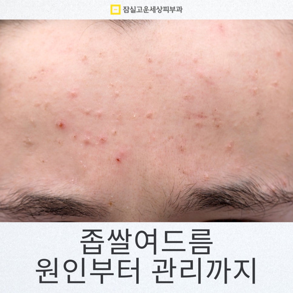 좁쌀여드름 완전 해결, 원인부터 관리까지 관련 이미지 1