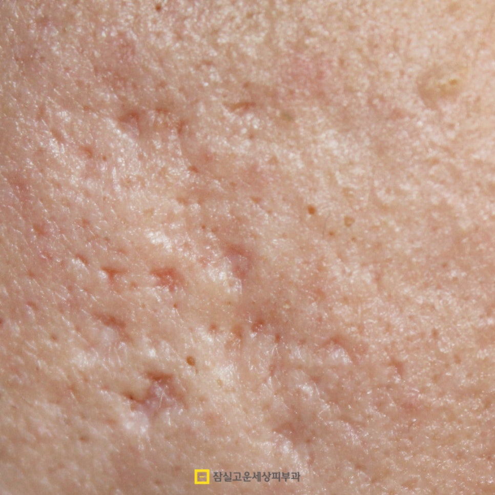 여드름 레이저 치료, 어떻게 작용하고 몇 번 받아야 할까? 관련 이미지 6