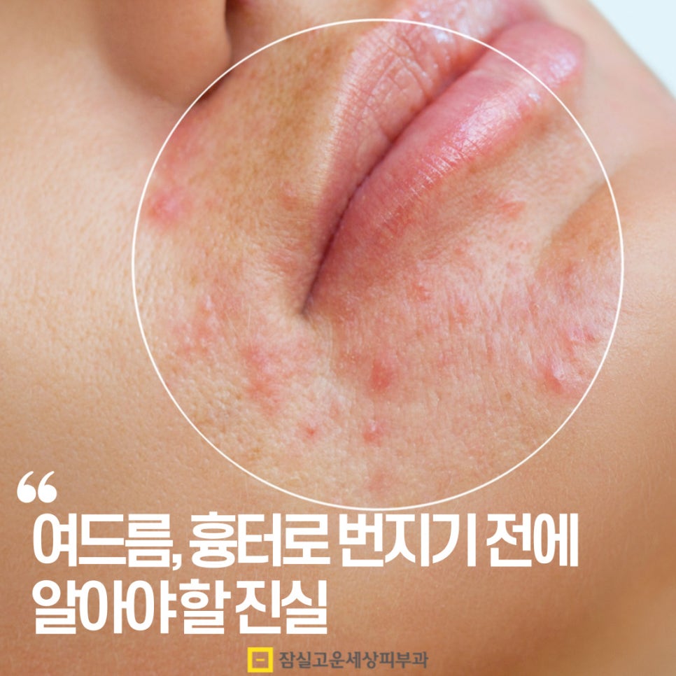 여드름, 흉터까지 번지기 전에 알아야 할 진실 관련 이미지 1