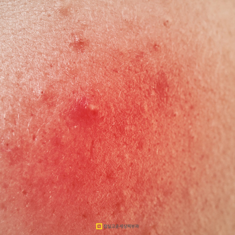 가려움, 홍조까지 부르는 지루피부염, 답은 여기에 있다. 관련 이미지 3