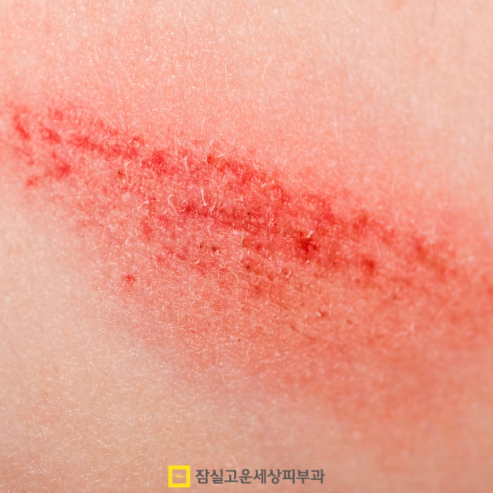 피부 건조, 원인부터 관리까지 알아보기 관련 이미지 11