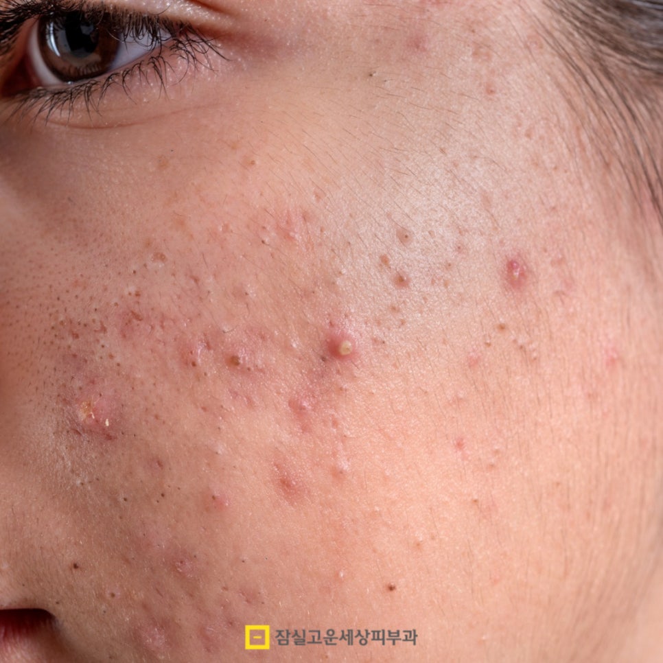 여드름, 왜 치료해도 다시 올라올가? 그리고 재발을 줄이는 방법 관련 이미지 2