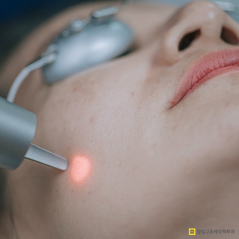 사마귀, 검버섯, 흑자 구분법 및 치료 가이드 관련 이미지 5