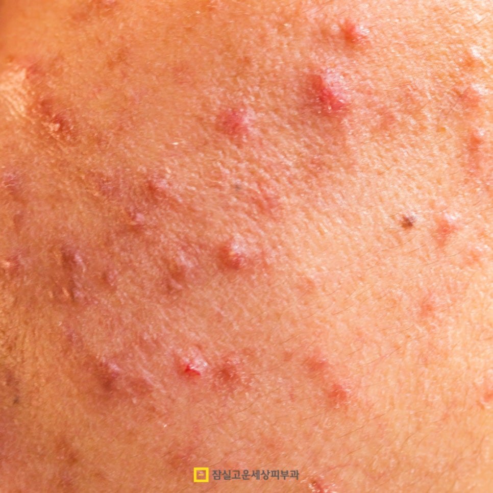 여드름 레이저 치료, 어떻게 작용하고 몇 번 받아야 할까? 관련 이미지 4