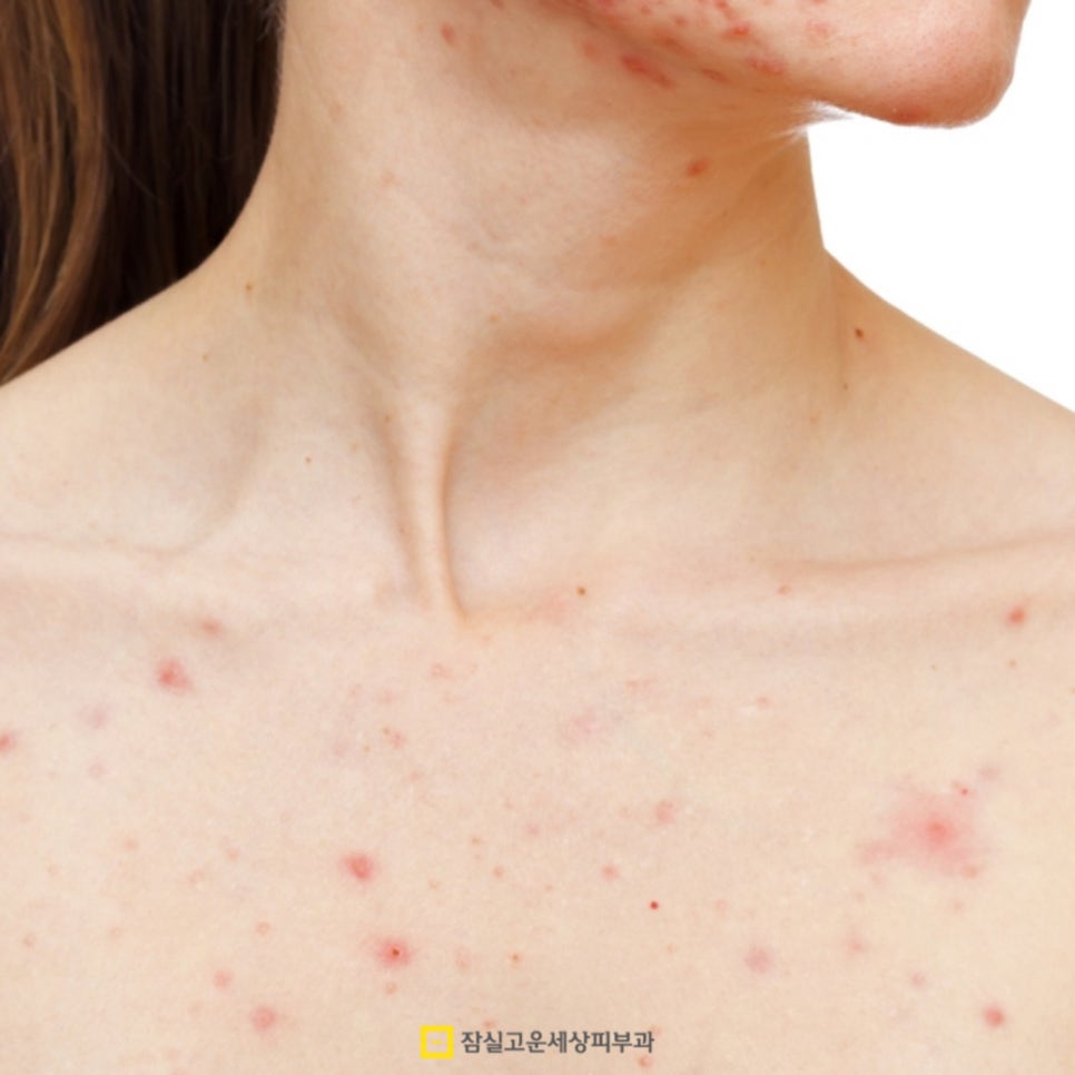 여름철 등드름과 가드름 완전 정복! 시원한 옷차림을 위한 완벽 가이드 관련 이미지 3