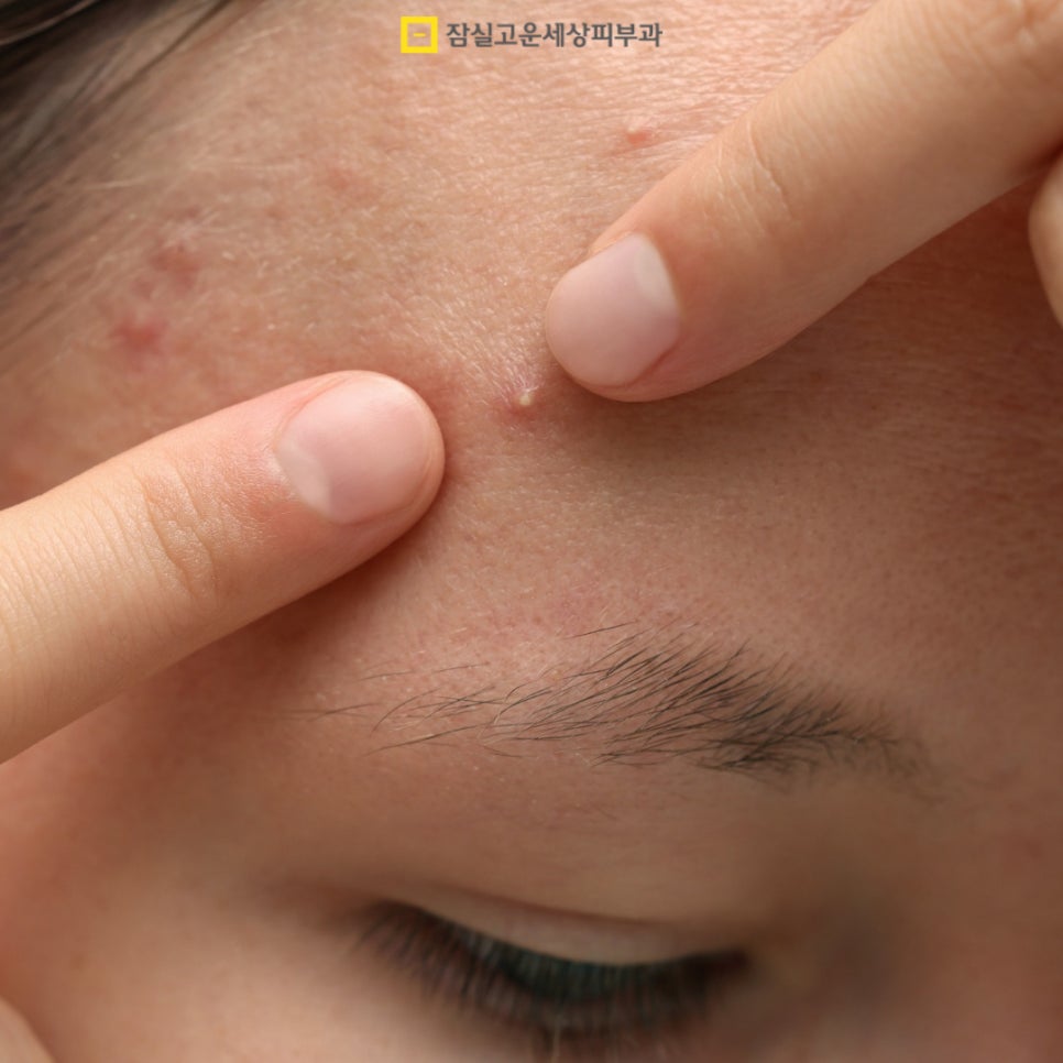 좁쌀여드름 완전 해결, 원인부터 관리까지 관련 이미지 2