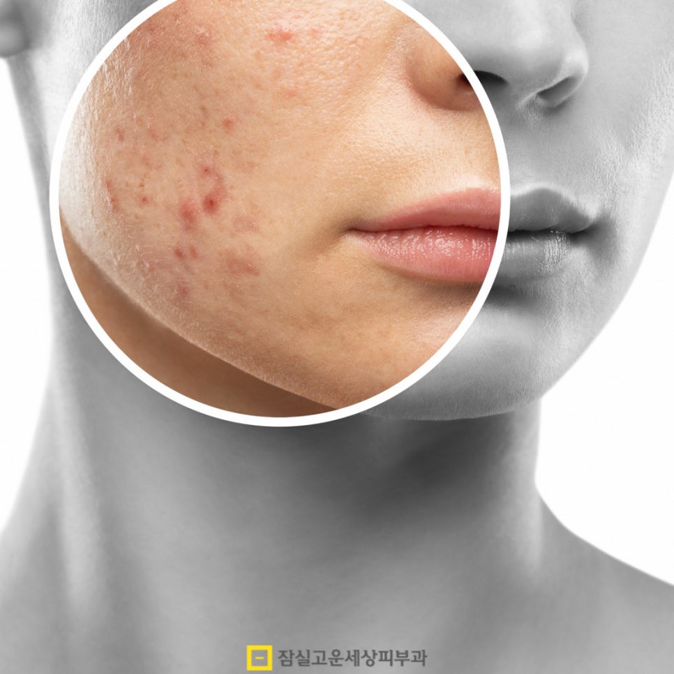 여드름, 흉터까지 번지기 전에 알아야 할 진실 관련 이미지 2