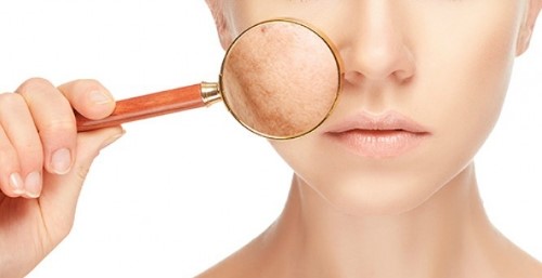 맑고 고운 유리알피부는 레블라이트로! (기미잡티제거/잠실피부과/잠실고운세상피부과) 관련 이미지 1