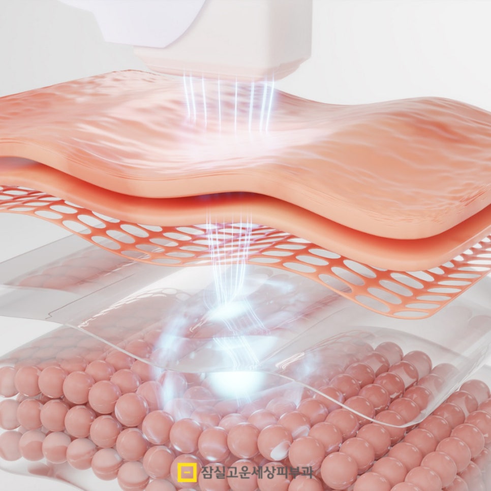 붉고 고름 찬 화농성 여드름의 원인부터 치료까지 관련 이미지 8