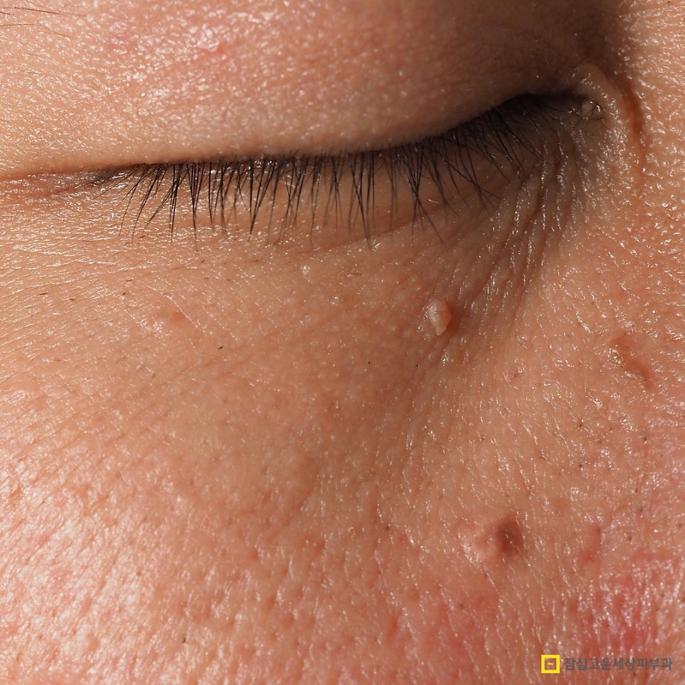 사마귀, 검버섯, 흑자 구분법 및 치료 가이드 관련 이미지 2