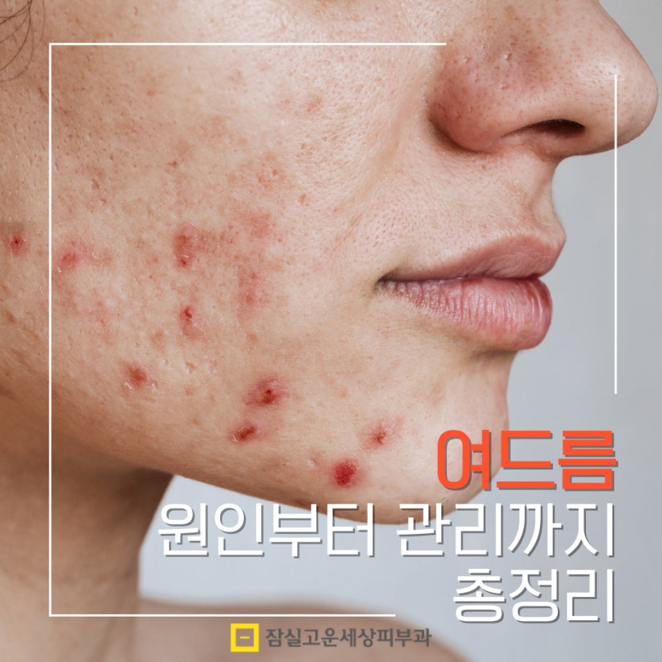 여드름, 단순한 뾰루지가 아닌 피부 질환 관련 이미지 1