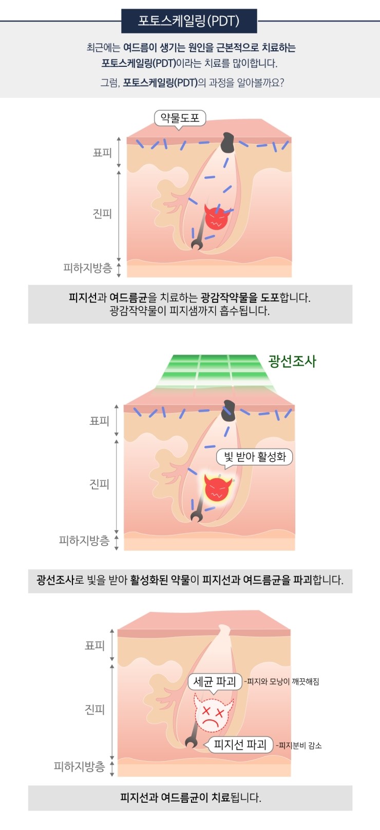 피지 폭발하는 여름, 화농성여드름 치료는 잠실여드름피부과에서! (잠실고운세상피부과/잠실역근처피부과/잠실여드름/핌클케어) 관련 이미지 9