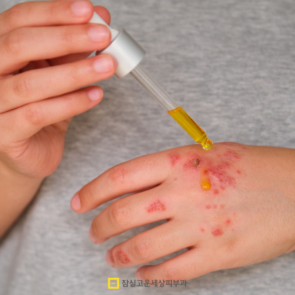 아토피 관리, 습관에서 시작되는 건강한 피부 관련 이미지 10