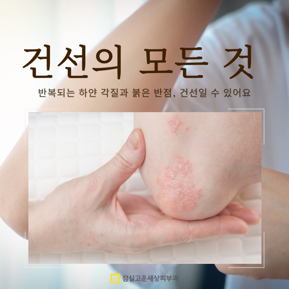 반복되는 하얀 각질과 붉은 반점, 건선일 수 있어요 관련 이미지 1