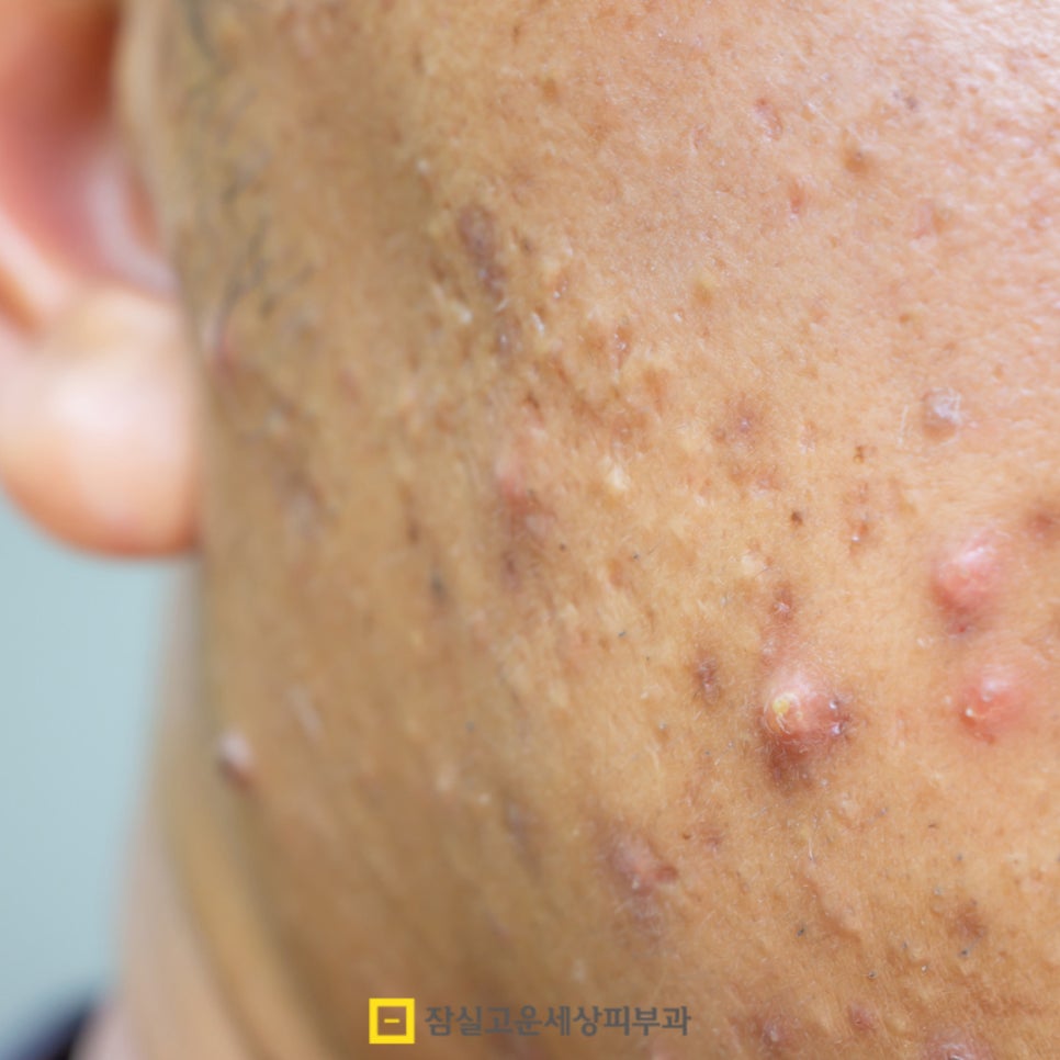여드름, 단순한 뾰루지가 아닌 피부 질환 관련 이미지 10
