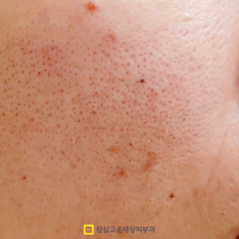 환절기 피부 고민, 딱 1가지 시술만 받는다면? 관련 이미지 6