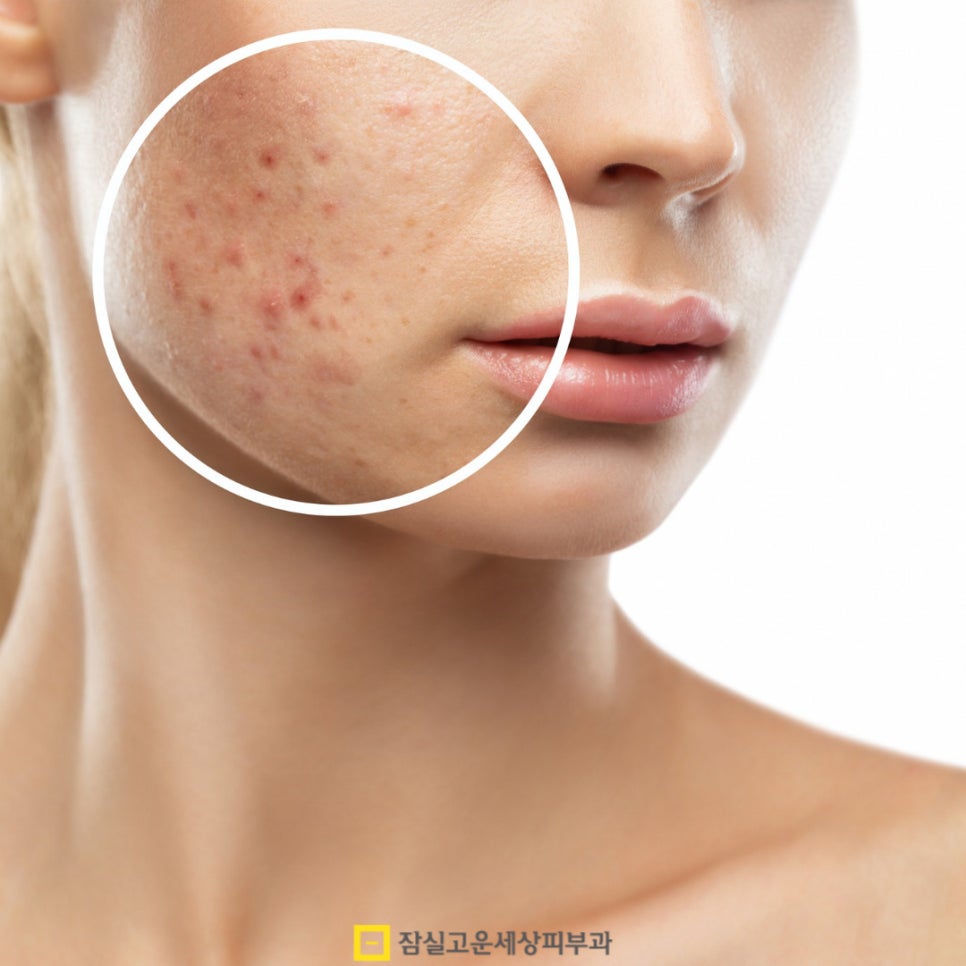 여드름, 흉터까지 번지기 전에 알아야 할 진실 관련 이미지 4