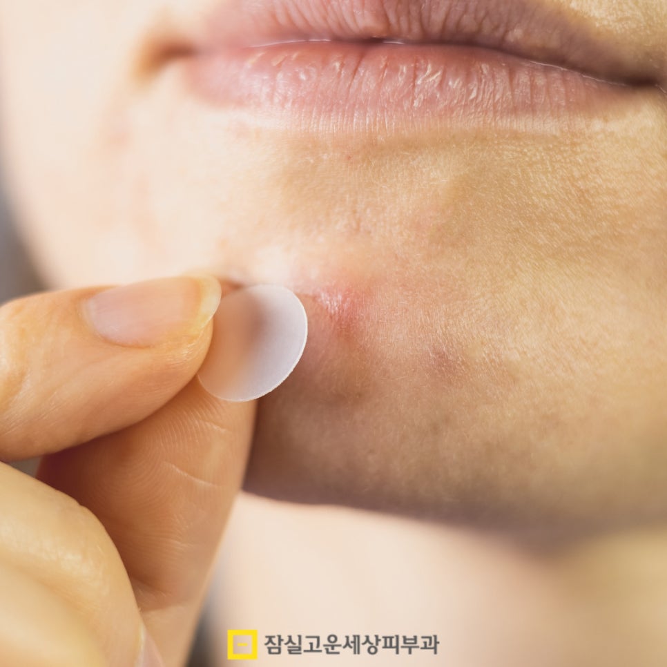 여드름 패치, 상황에 맞게 제대로 쓰는 법 관련 이미지 7