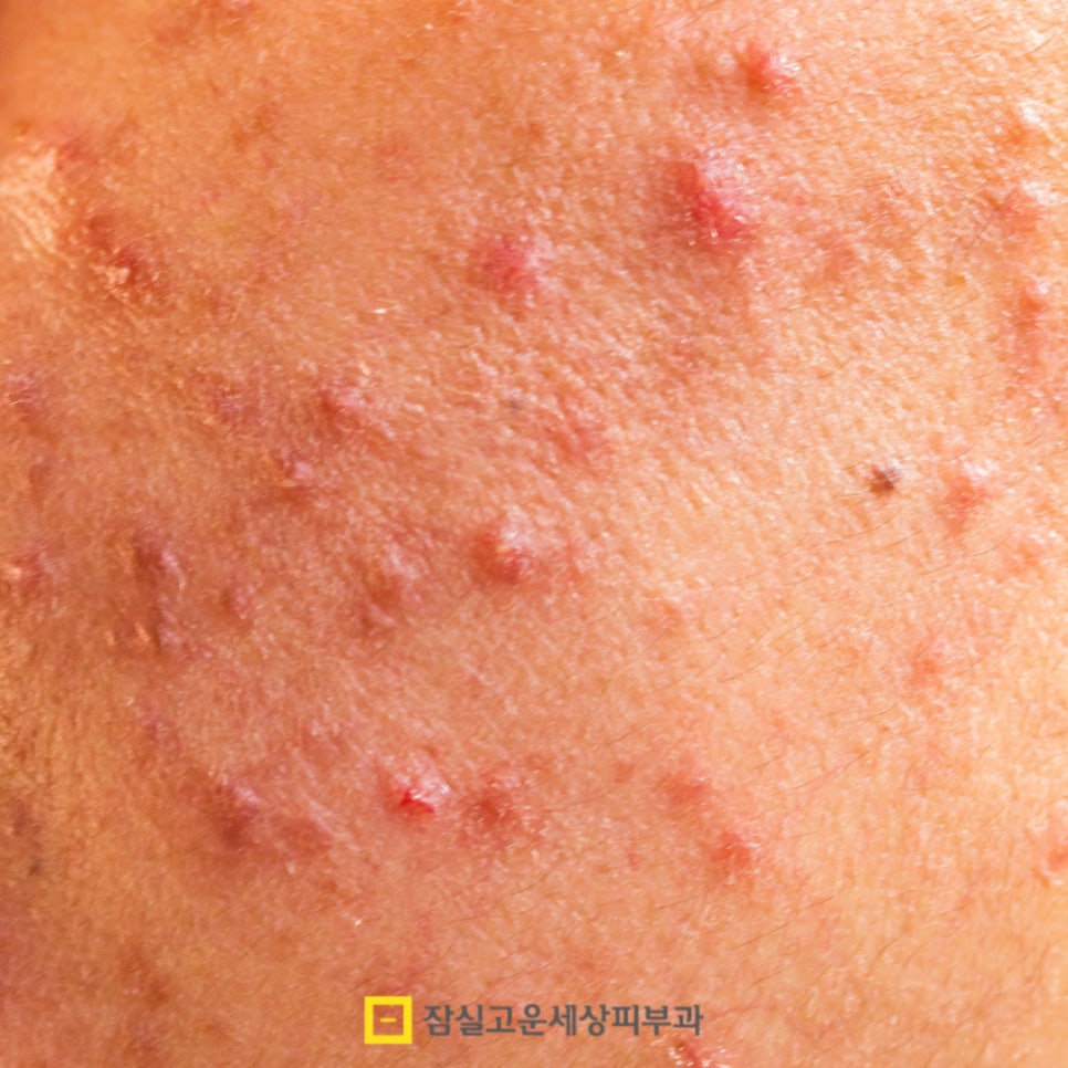 여드름 약, 복용 전 꼭 알아야 할 5가지 핵심 포인트 관련 이미지 3