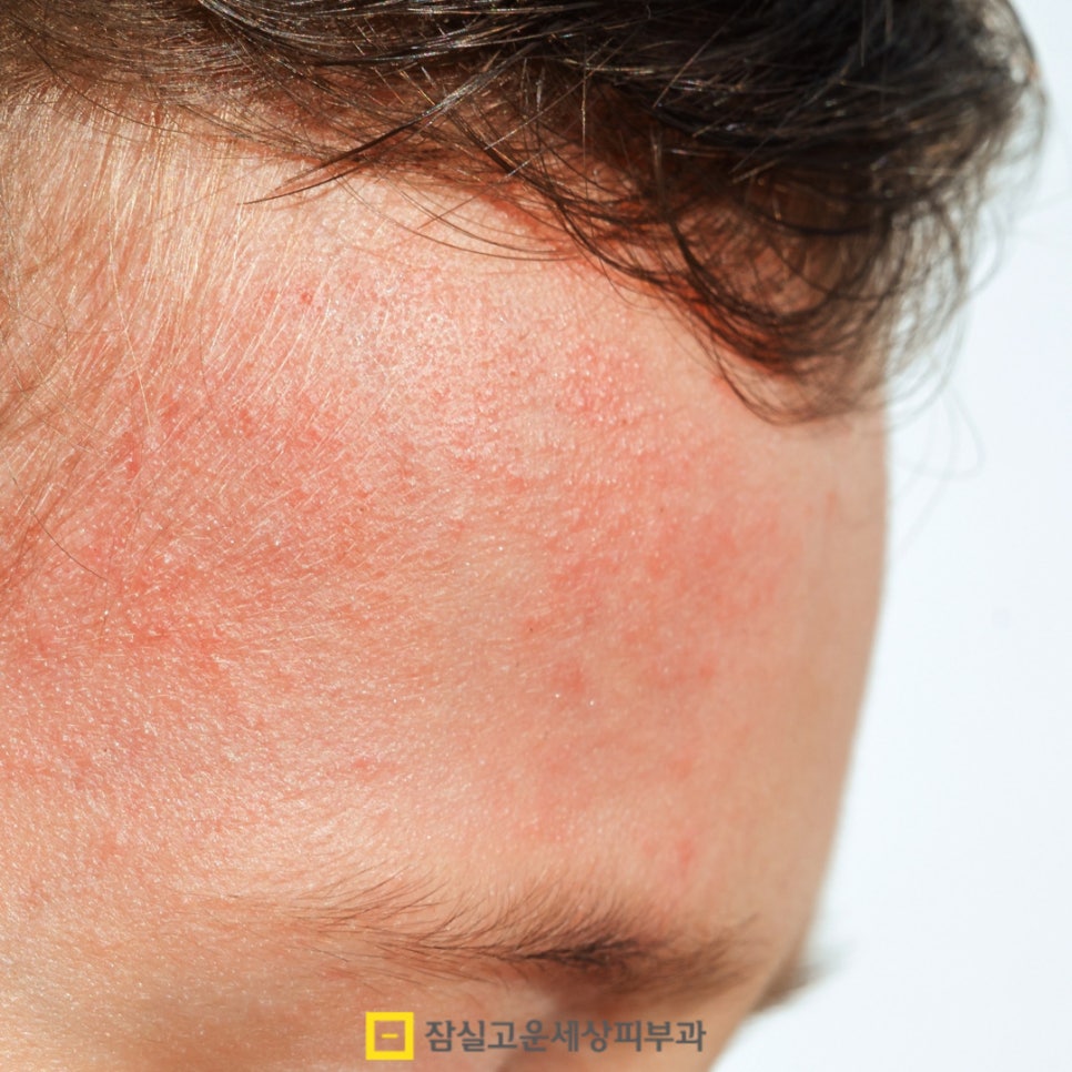 갑자기 트러블이 많아졌다면, 환절기 알러지성 피부일 수도 있어요 관련 이미지 2