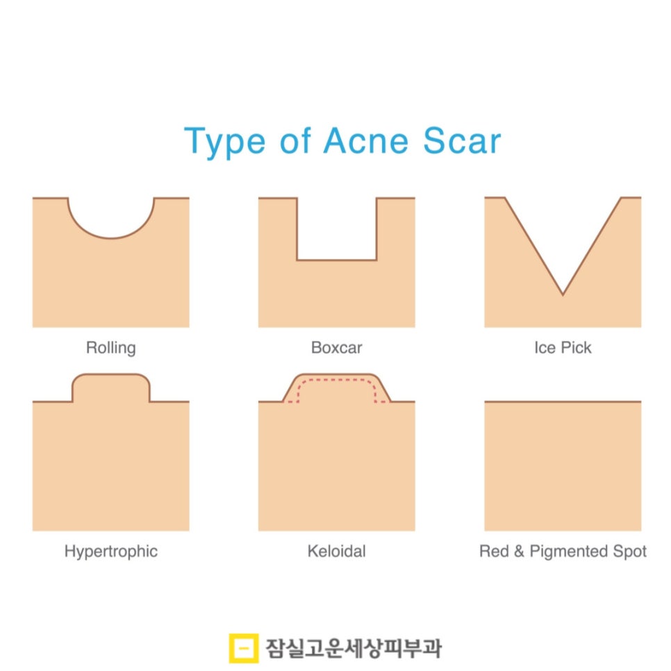 여드름 흉터 치료, 피부 타입별로 접근이 달라야 하는 이유 관련 이미지 4