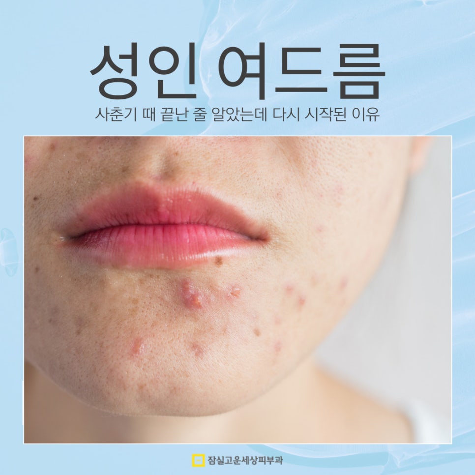 성인 여드름, 사춘기 때 끝난 줄 알았는데 다시 시작된 이유 관련 이미지 1