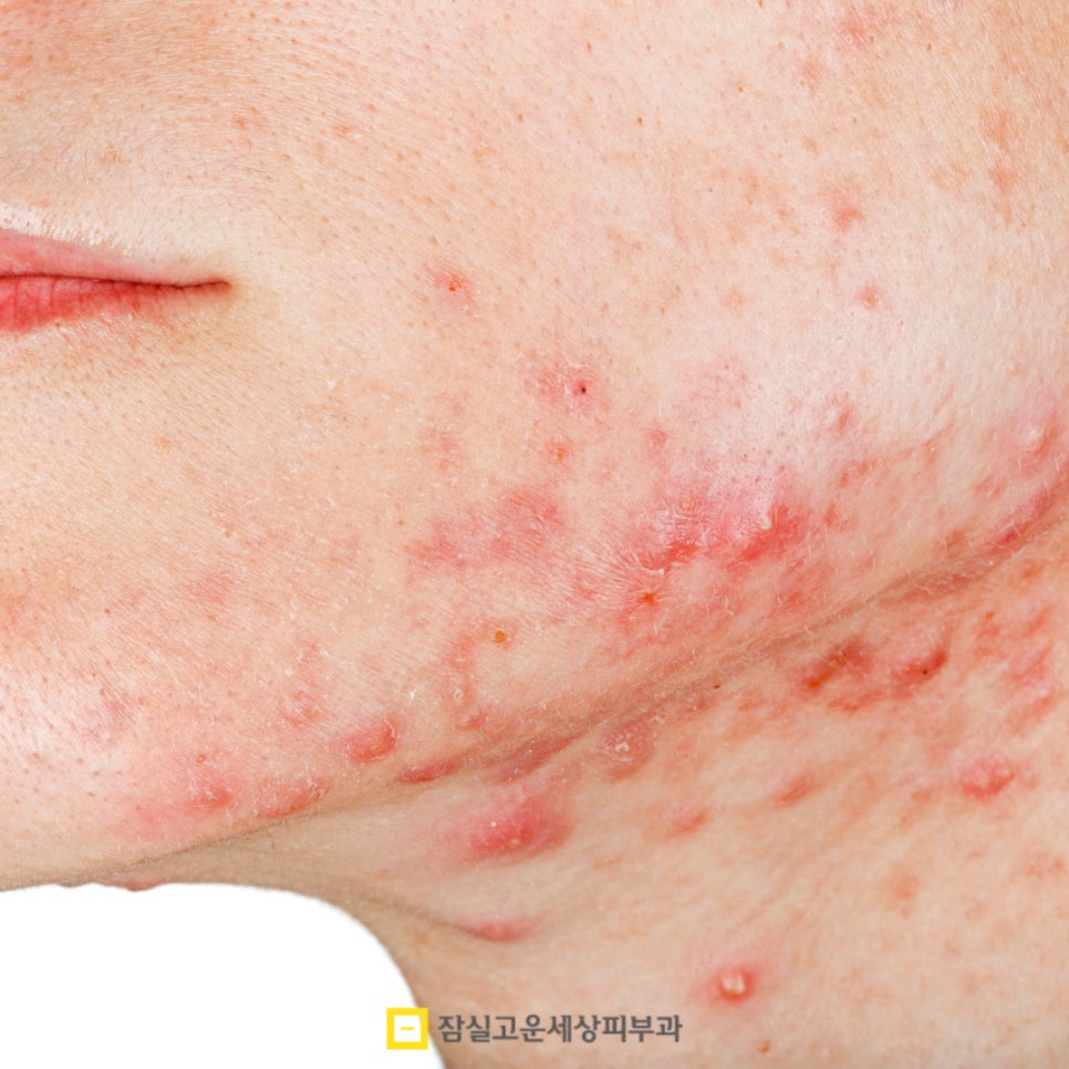 붉고 고름 찬 화농성 여드름의 원인부터 치료까지 관련 이미지 5