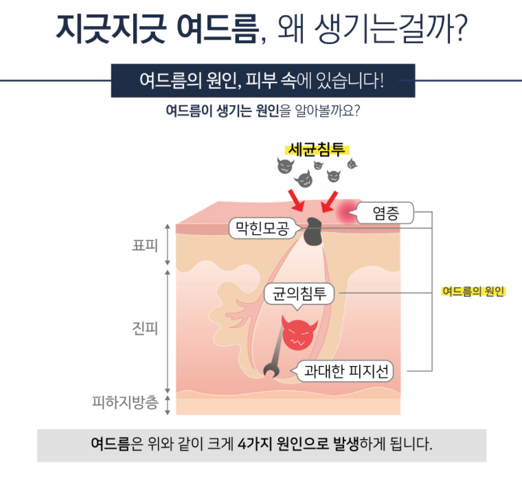 피지 폭발하는 여름, 화농성여드름 치료는 잠실여드름피부과에서! (잠실고운세상피부과/잠실역근처피부과/잠실여드름/핌클케어) 관련 이미지 8